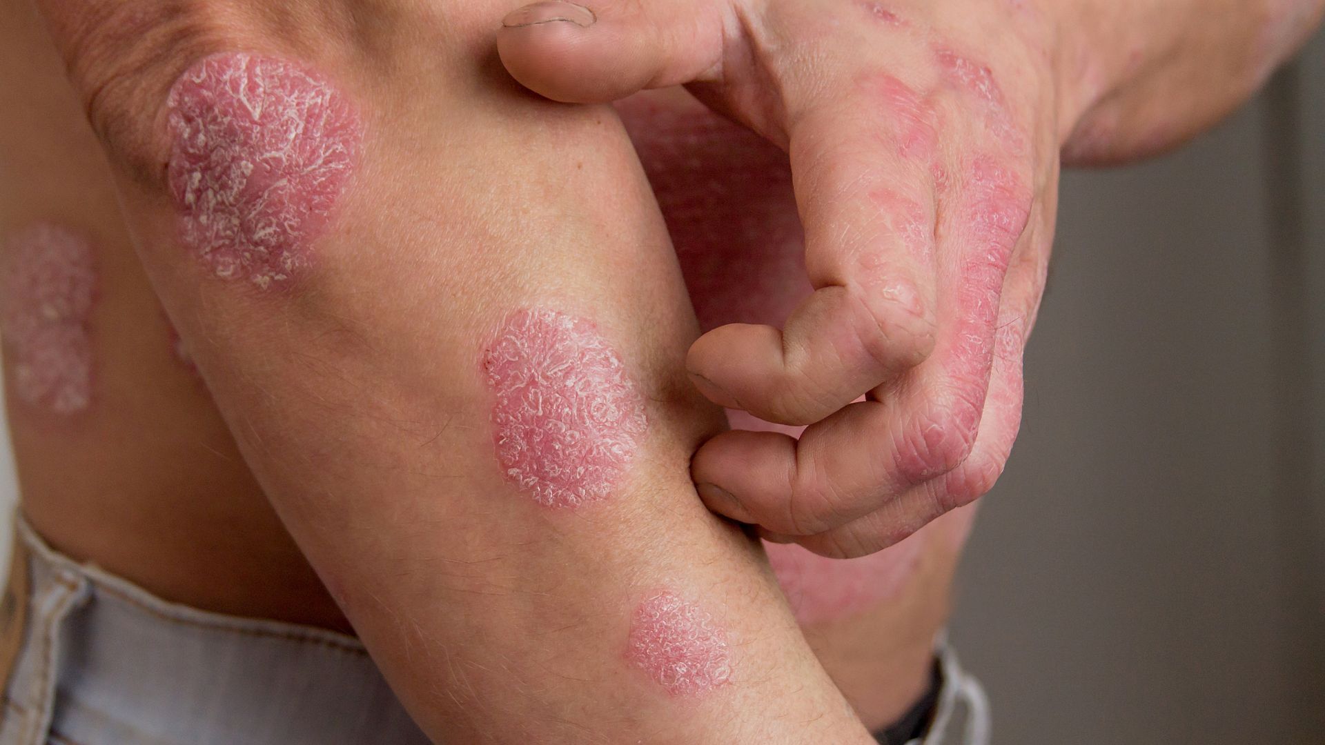What is Psoriasis?
