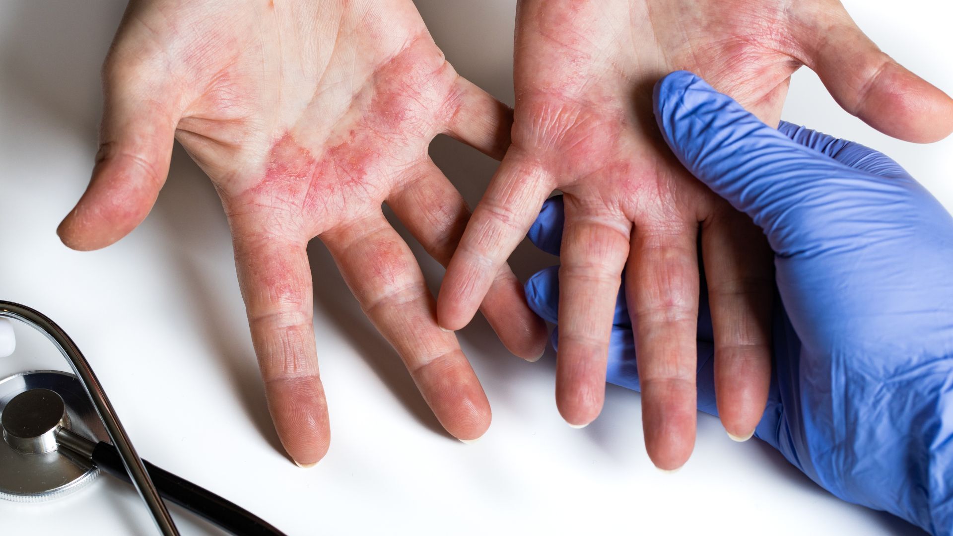 What Is Atopic Dermatitis? Causes, Symptoms, and the Role of Research