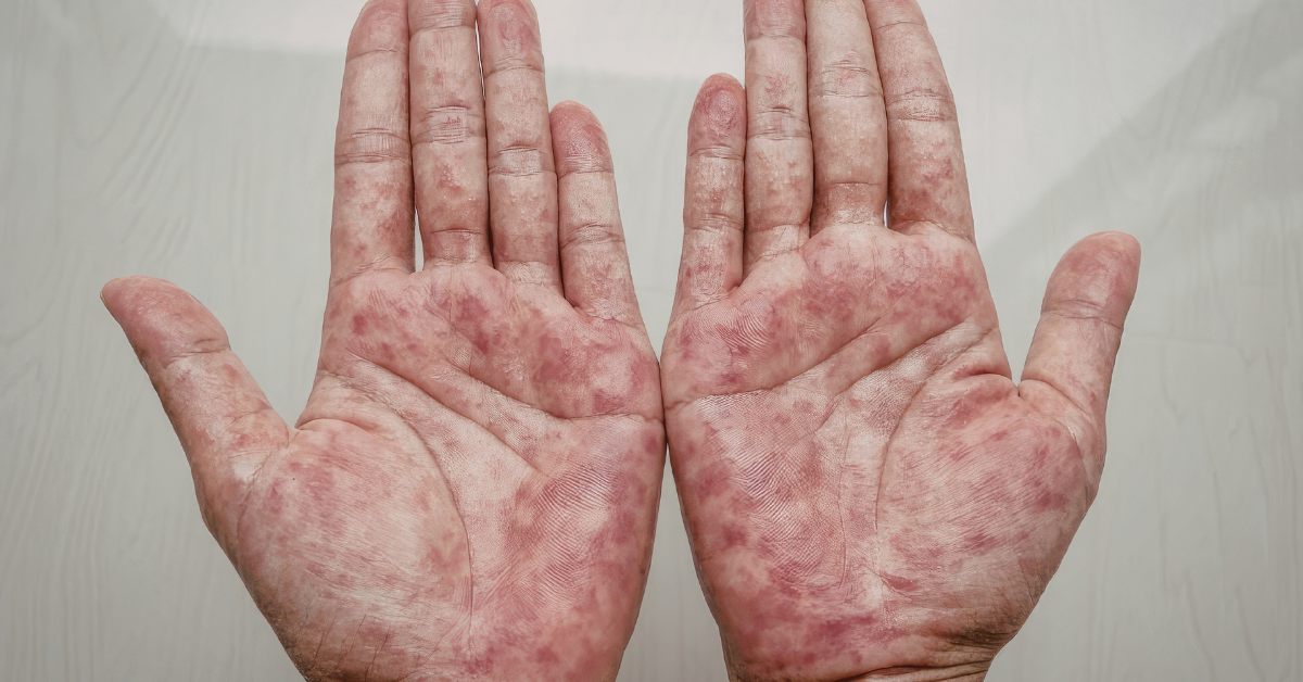 Why Researchers Study Skin&nbsp;From&nbsp;People&nbsp;With&nbsp;Eczema (Atopic Dermatitis)
