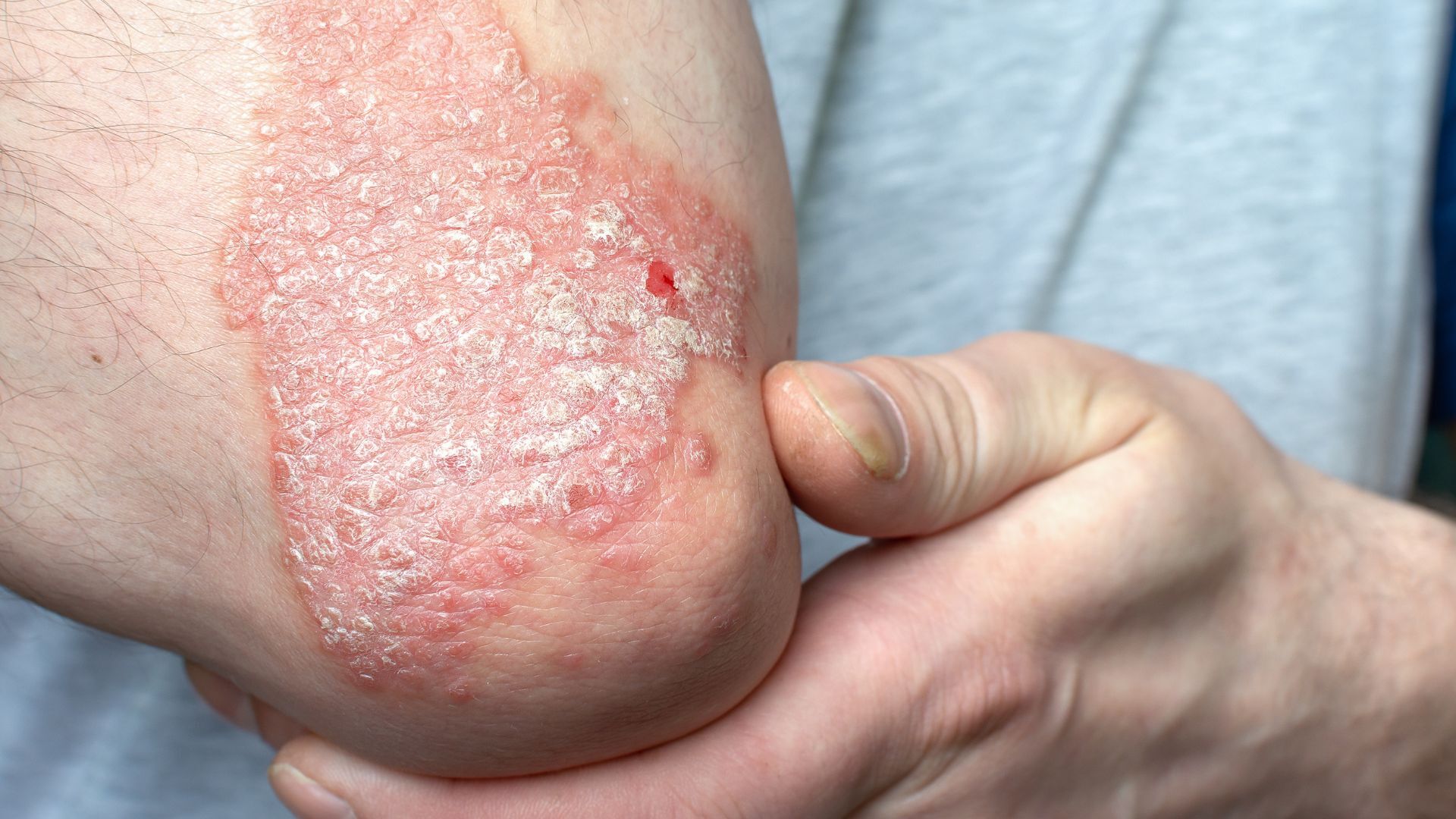 Why Researchers Study Tissue From People with Psoriasis