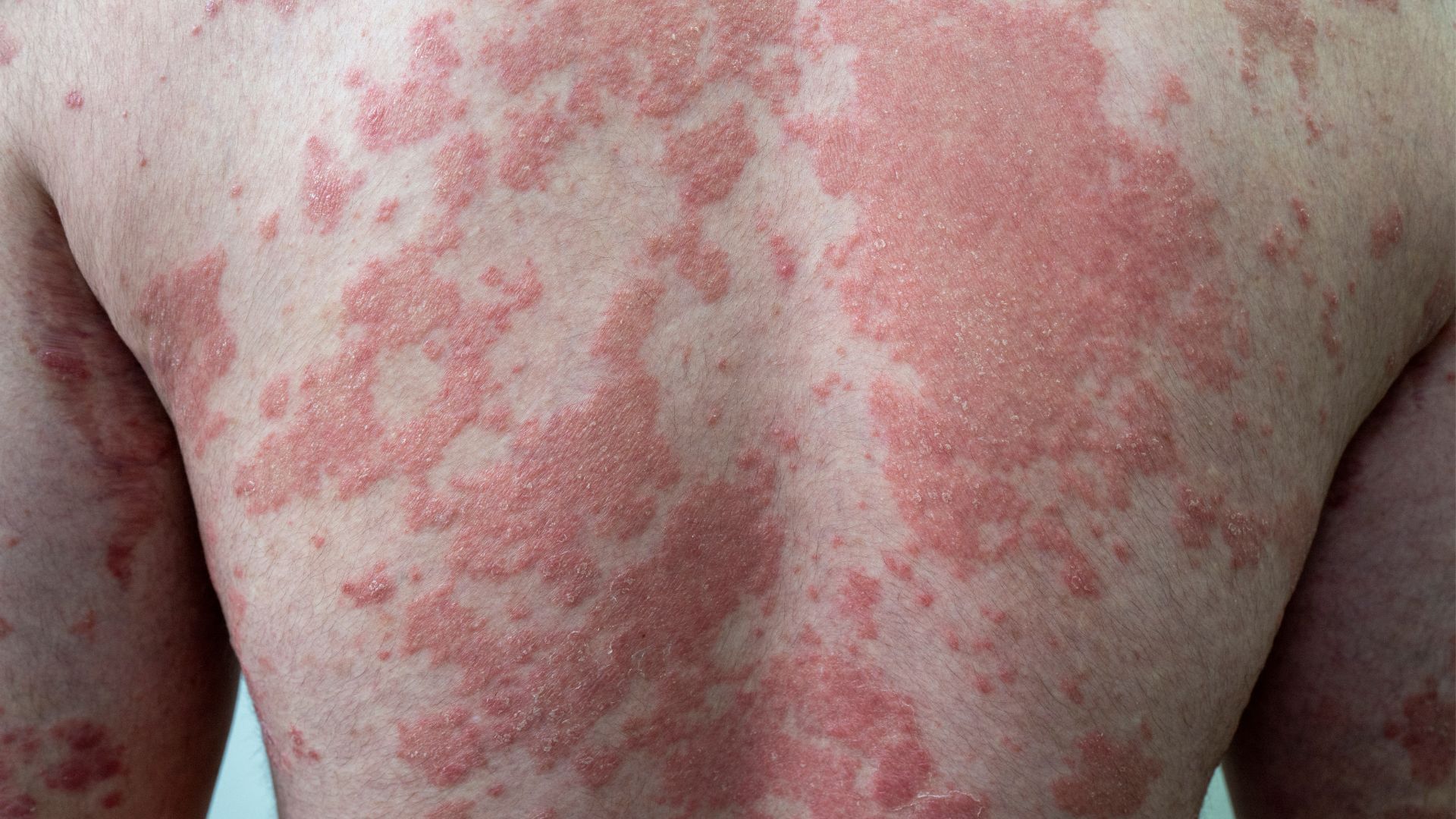 How Studying Human Skin Helps Find Better Psoriasis Treatments